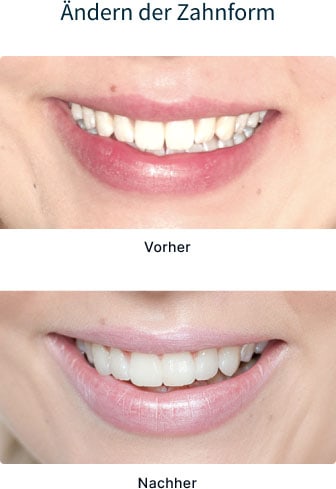 Vor- und Nacher-Bild - Zahnform