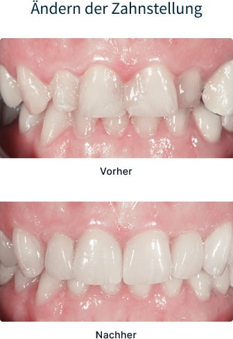 Vor- und Nacher-Bild - Zahnstellung