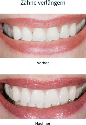 Vor- und Nacher-Bild - Zahnverlängerung