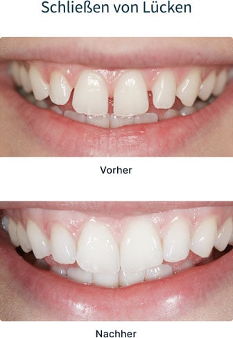 Vor- und Nacher-Bild - Zahnlücke