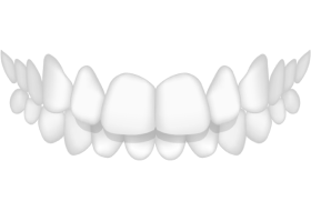 Zahnschema - Überbiss