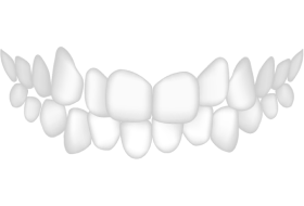 Zahnschema - Zahnkippung